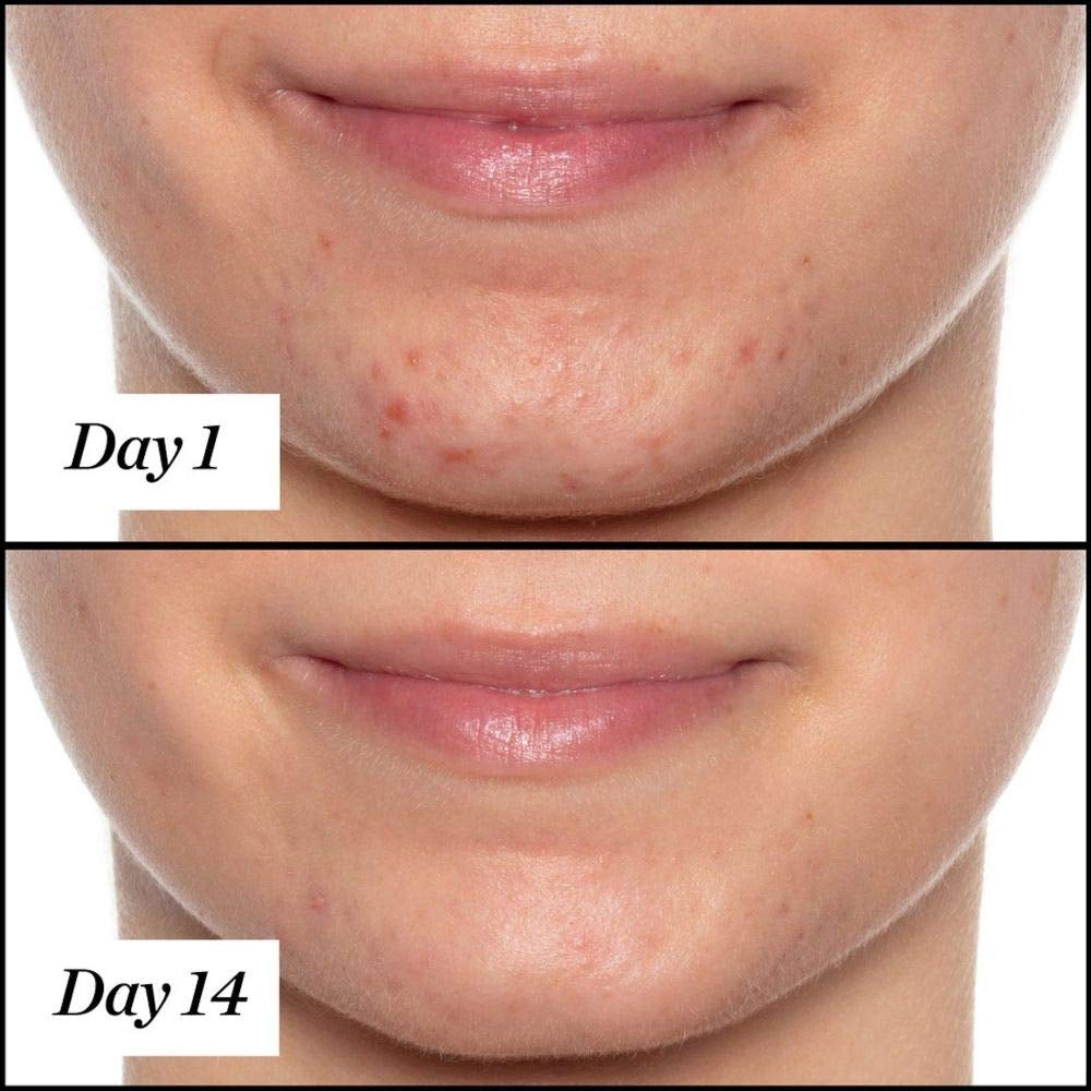 Sunday Riley U.F.O. Ultra-Clarifying Salicylic Acid and Tea Tree Acne Treatment Face Oil