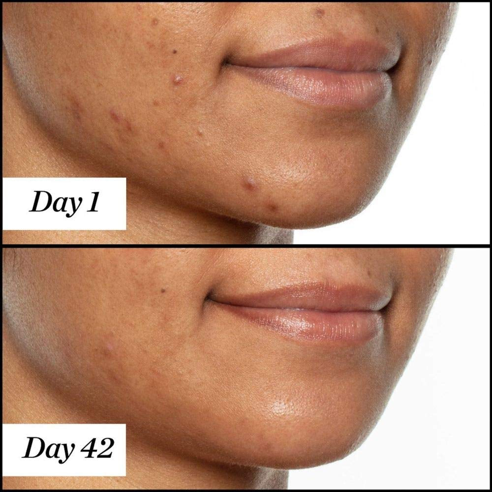 Sunday Riley U.F.O. Ultra-Clarifying Salicylic Acid and Tea Tree Acne Treatment Face Oil