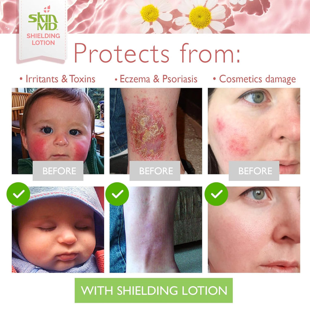 Skin MD Shielding Lotion Hydrating Body Lotion for Sensitive Skin with Dispenser | Non-Greasy, Fast-Absorbing Moisturizer with Plant-Based Ingredients, Eczema & Psoriasis Relief - 8Oz Pump